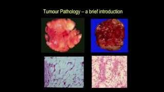 Tumour pathology  a brief introduction part III [upl. by Ativak]