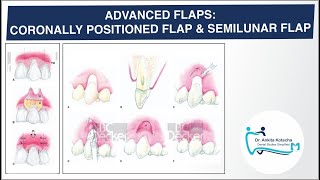 ADVANCED PEDICLE FLAPS CORONALLY POSITIONED FLAP SEMILUNAR FLAP ROOT COVERAGE DR ANKITA [upl. by Nicole110]