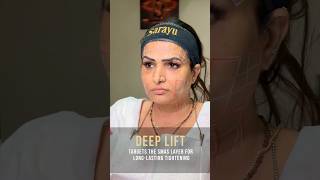 NonSurgical Facelift with HIFU by Dr Adarsh Tripathi  Sarayu Clinics hifu [upl. by Hamrnand566]