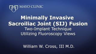 Minimally Invasive Sacroiliac Joint SIJ Fusion Twoimplant technique utilizing Fluoroscopy views [upl. by Maitilde42]