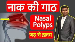 नाक की गाठ जड़ से ख़तम  Nasal polyps treatment without Operation Hindi I nak ki gath nak ki haddi [upl. by Atenek]