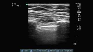 Lung ultrasound quotLung Pointquot [upl. by Inattyrb]