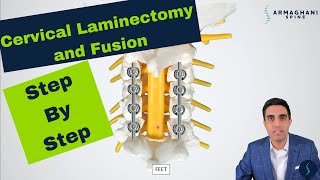 Posterior Cervical Laminectomy and Fusion  Procedure details recovery and expectations [upl. by On327]