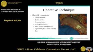 Onestage minimallyinvasive IvorLewis esophagectomy without patient repositioning [upl. by Anolahs757]