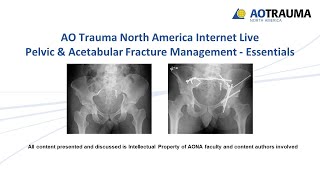 Hip joint articular surface acetabular labrumHip Complex Biomechanics [upl. by Omrellug409]