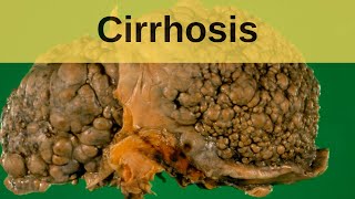 Cirrhosis  Pathology mini tutorial [upl. by Rosinski]