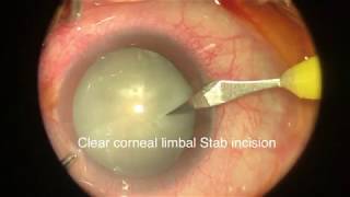 Tips And Tricks In Making Side Port Incisions Paracentesis During Phaco Surgery [upl. by Holly115]