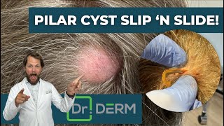 Pilar Cyst  Dr Derm [upl. by Tersina]