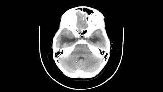 Hidrocefalia não comunicante com glioma do teto do mesencéfalo [upl. by Michaeu186]