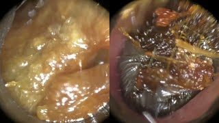 145  Masses of Ear Wax Removed from Interior amp Anterior Recess of Bendy Ear using WAXscope®️ [upl. by Ttiwed]