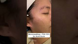 Microneedling plus TCA 15 peel for Acne Scars Shorts [upl. by Stillman112]