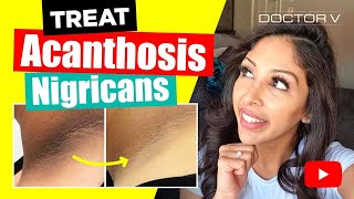 Doctor V  How To Treat Acanthosis Nigrican  Skin Of Colour  Brown Or Black Skin [upl. by Gaile92]