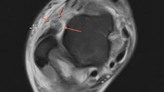 Anterior talofibular ligament tear and posterior tibial tendon tear [upl. by Cedell963]