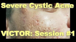 Severe Cystic Acne  Victor Session 1 [upl. by Jessabell]