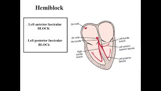 Hemiblock  LPFB  LAFB [upl. by Nirrac]