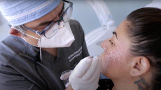 TCA Cross  Acne Scarring Treatment  West Hollywood CA  Dr Jason Emer [upl. by Litch682]