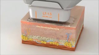 The svideo of treatment principle of HIFU skin rejuvenation machine whtasapp 8613570586721 [upl. by Mcleod]