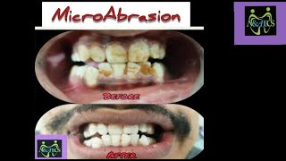 Microabrasion  Unsung heroic Dental Treatment [upl. by Assiren155]