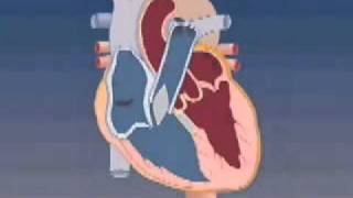 Tetralogy of Fallot TOF [upl. by Atekihs379]