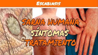 ⚕️🩺 ESCABIOSIS o SARNA HUMANA Síntomas y Tratamiento [upl. by Onaireves528]