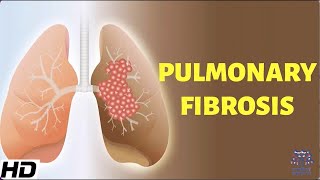 Pulmonary Fibrosis Everything You Need To Know [upl. by Aynotak]