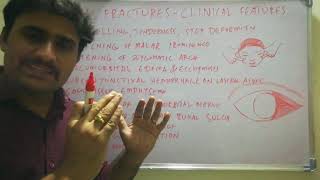 ZMC FRACTURES  Clinical features and diagnosis [upl. by Prent]