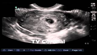 Introduction to pelvic ultrasonography [upl. by Nomzaj]