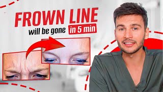 TWO Effective Exercises to Eliminate Frown Lines  Get Rid of Frown Lines in Just 5 Minutes a Day [upl. by Adnalro]