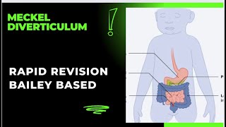 Meckel Diverticulum  Bailey Based  Rapid Revision  neetss2024 surgeryeducation surgeon [upl. by Sined]