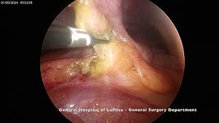 Epiploic Appendagitis [upl. by Sausa]