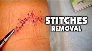 REMOVING 13 STITCHES From a Huge Leg Wound  Dr Paul [upl. by Nenad]