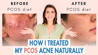 How I Healed My Cystic Acne NATURALLY PCOS amp Hormonal Acne [upl. by Eilsehc]