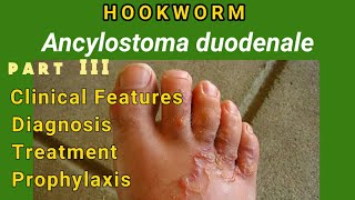 Hookworm  Ancylostomiasis Clinical Features Diagnosis Treatment Prophylaxis  AM Biologie Notes [upl. by Newby]