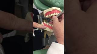 Instrumentation on Mandible with Universal Curettes part 1 [upl. by Nolla]