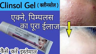 Clinsol Gel Review In Hindi  एक्ने पिम्पलस ऑयली स्किन की असरदार दवा [upl. by Phyllida114]