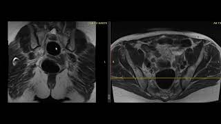 Understanding the different types of Ovarian Cysts [upl. by Arleyne]