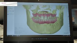 IDS2017 3Shape Ortho Analyzer  Diagnostics Analysis and Treatment Planning [upl. by Wiese]