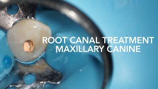 Root Canal Treatment on Maxillary Canine Tooth 23 [upl. by Iams]