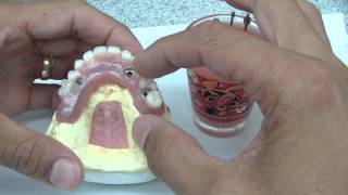 Overdenture Abutment Part 1 [upl. by Jo-Anne]