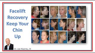 Facelift Recovery Keep Your Chin Up [upl. by Shaper]