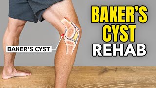 Bakers Cyst Treatment Rehab Exercises [upl. by Nyleda967]