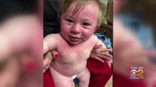 Child Has Anaphylactic Reaction To Paint With DairyBased Ingredients [upl. by Jarad]