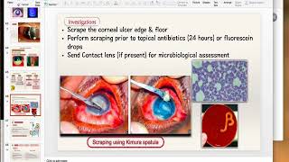 Bacterial Keratitis Part 2 [upl. by Stimson]