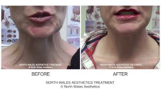 Botox Treatment Neck Platysmal Muscles Before amp After Video [upl. by Eilrahs75]