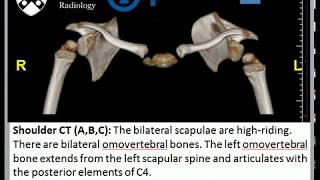 Sprengel Deformity [upl. by Mcilroy]