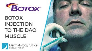 The DAO Muscle  BOTOX® Injections in Dallas [upl. by Seravaj989]