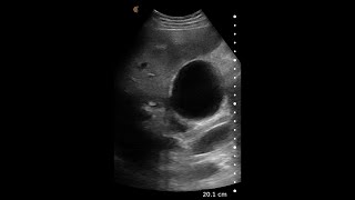 Cholecystitis – Ultrasound Image Interpretation [upl. by Aohk212]