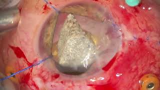 Giant Intraocular Foreign Body Removal via Limbal Insicion [upl. by Bram]