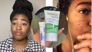 How I got rid of my acne after 12 years  Differin gel review [upl. by Ovatsug22]