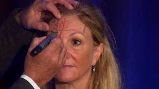 Injectors Anatomy of the Forehead [upl. by Dysart]